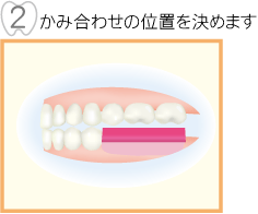 かみ合わせの位置を決めます