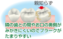 親知らずがむし歯の原因になる